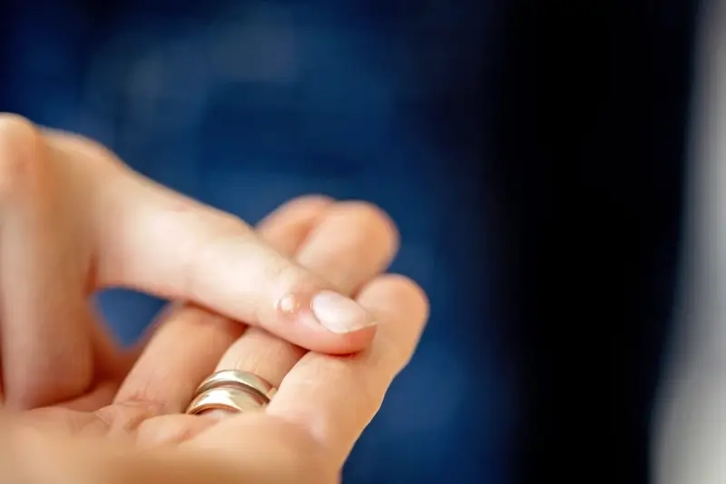 Co dobrego na kurzajki u dzieci?