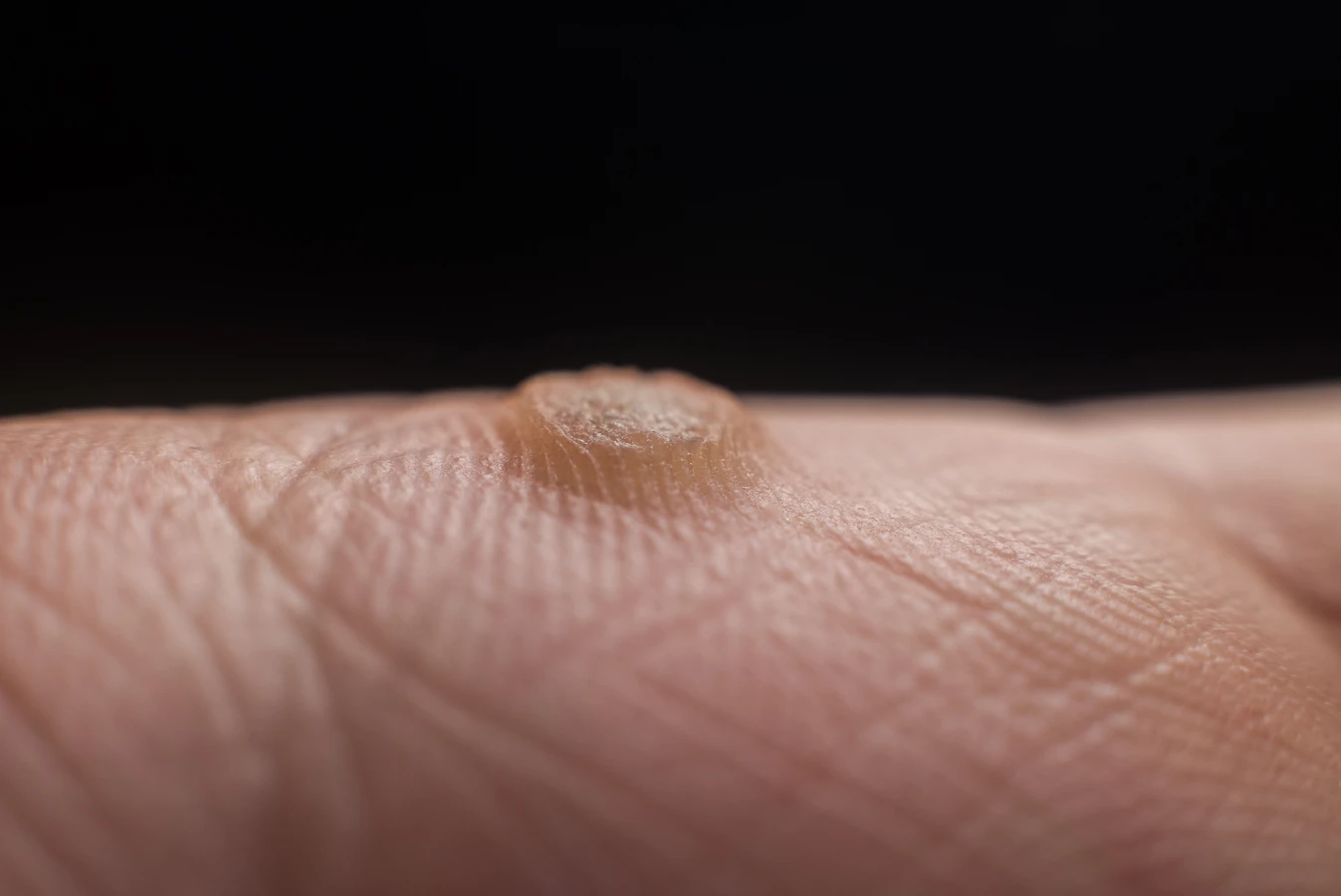 Czy kurzajki są groźne?