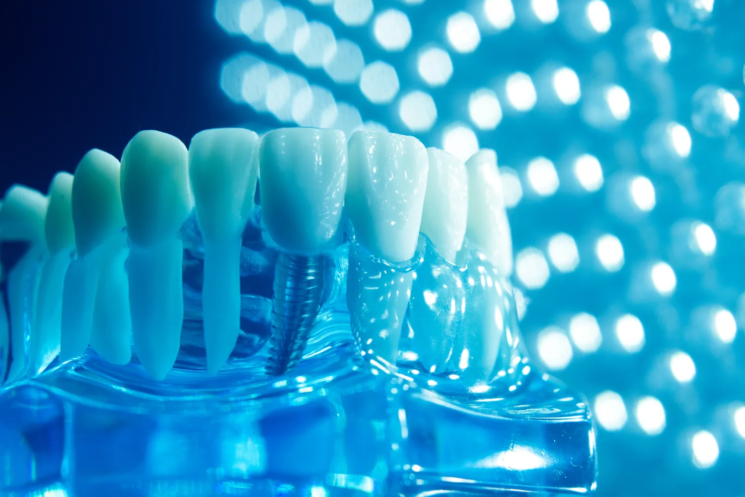 Implanty zębów cała szczęka Szczecin