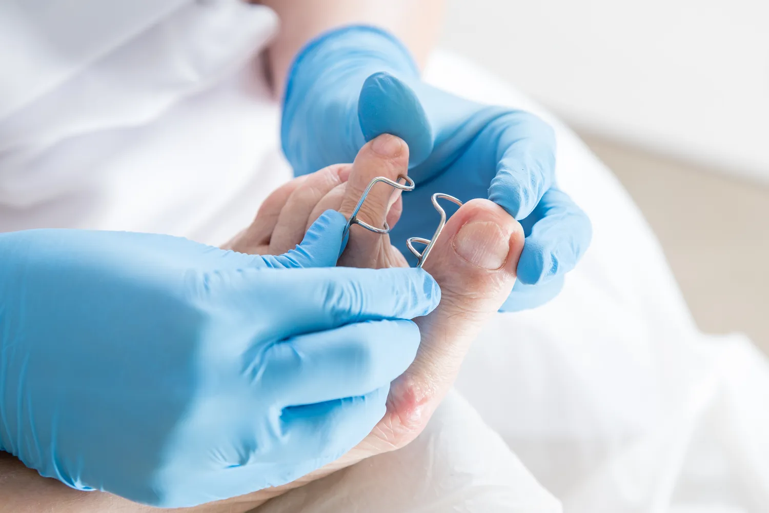 Odcisk, kurzajka, nadpotliwość? Zgłoś się do podologa